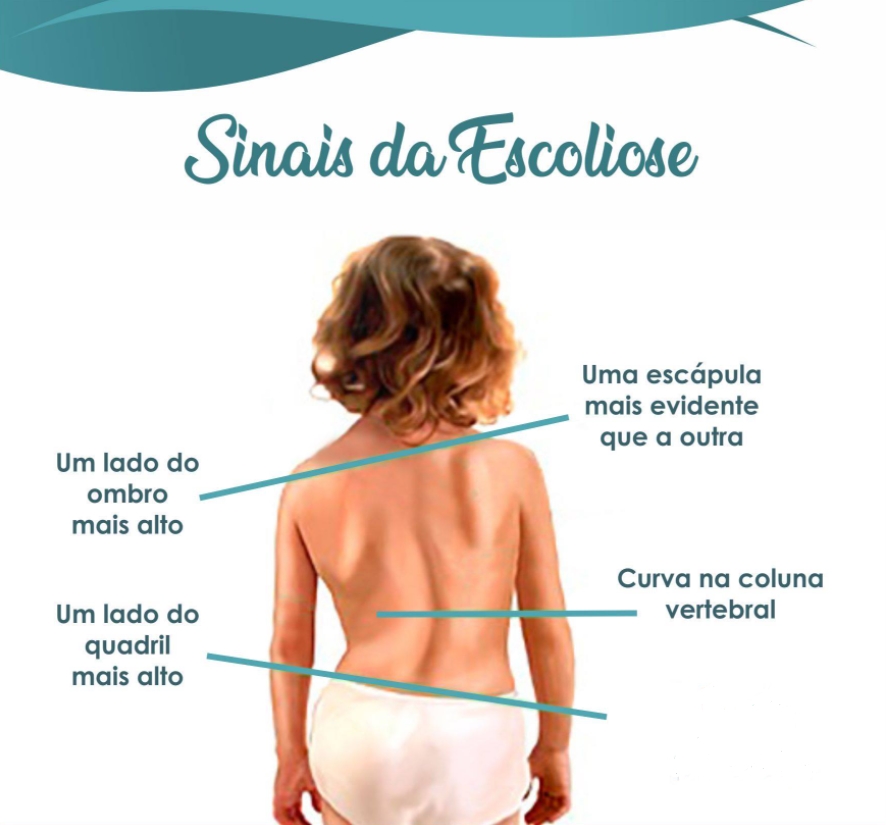 A osteopatia no tratamento da escoliose